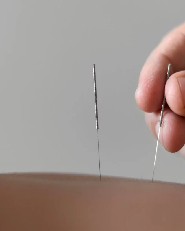 Dry needling treatment targeting muscle trigger points