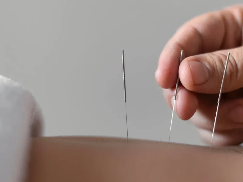 Dry needling therapy