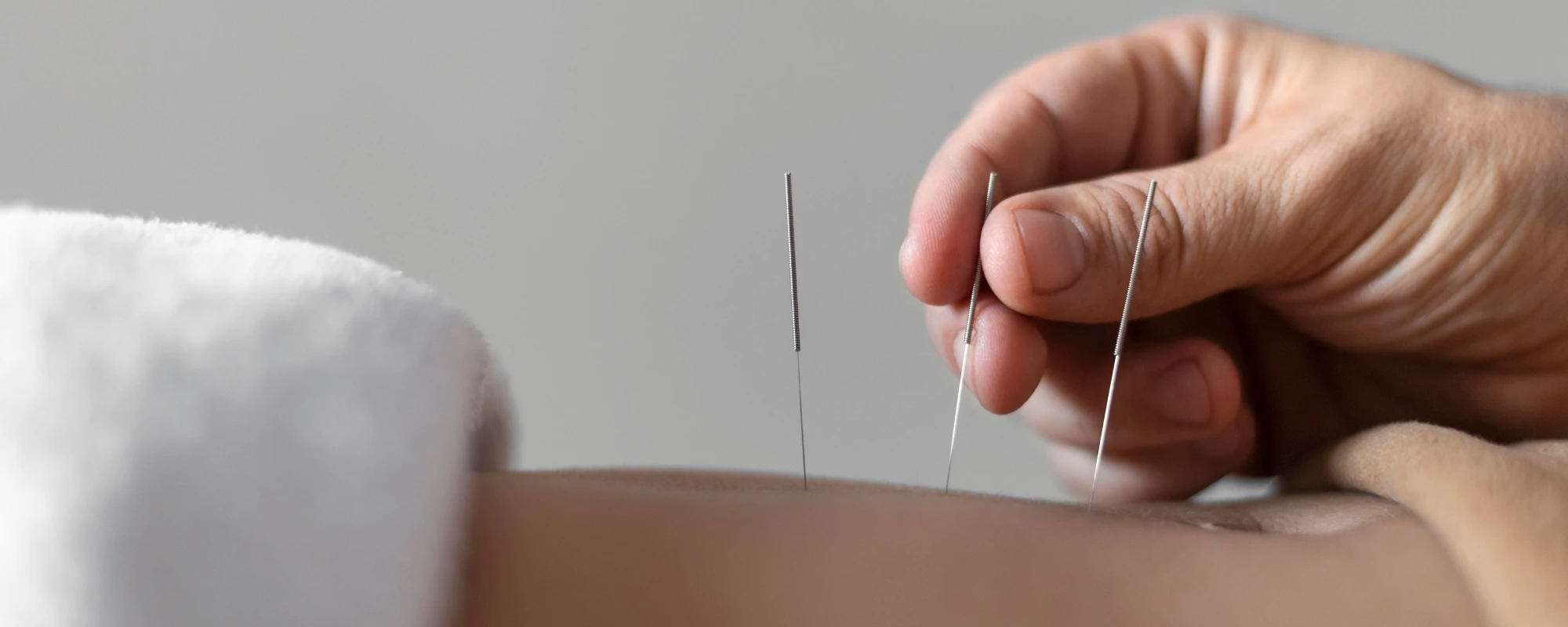 Dry Needling